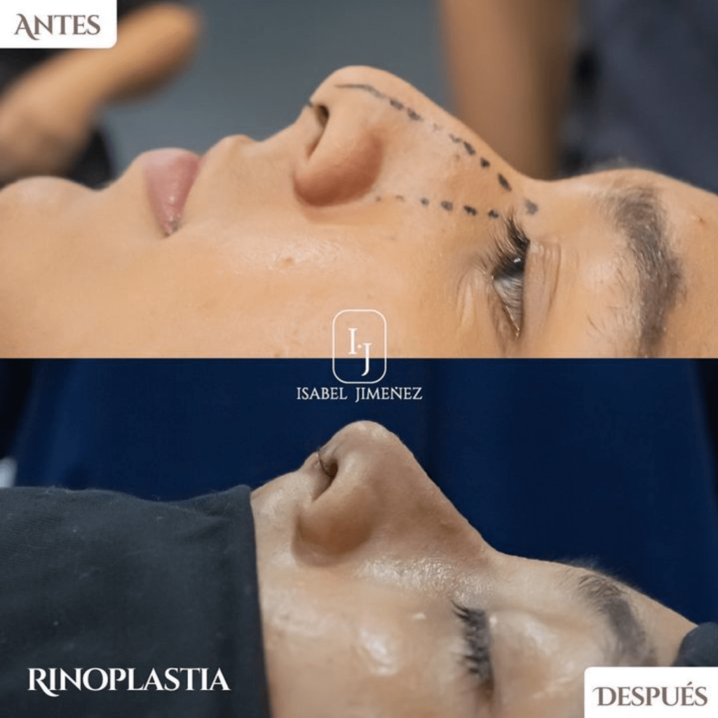 Rinoplastia Dra Isabel Jimenez