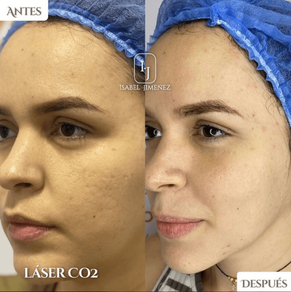 Laser CO2 Dra Isabel Jimenez