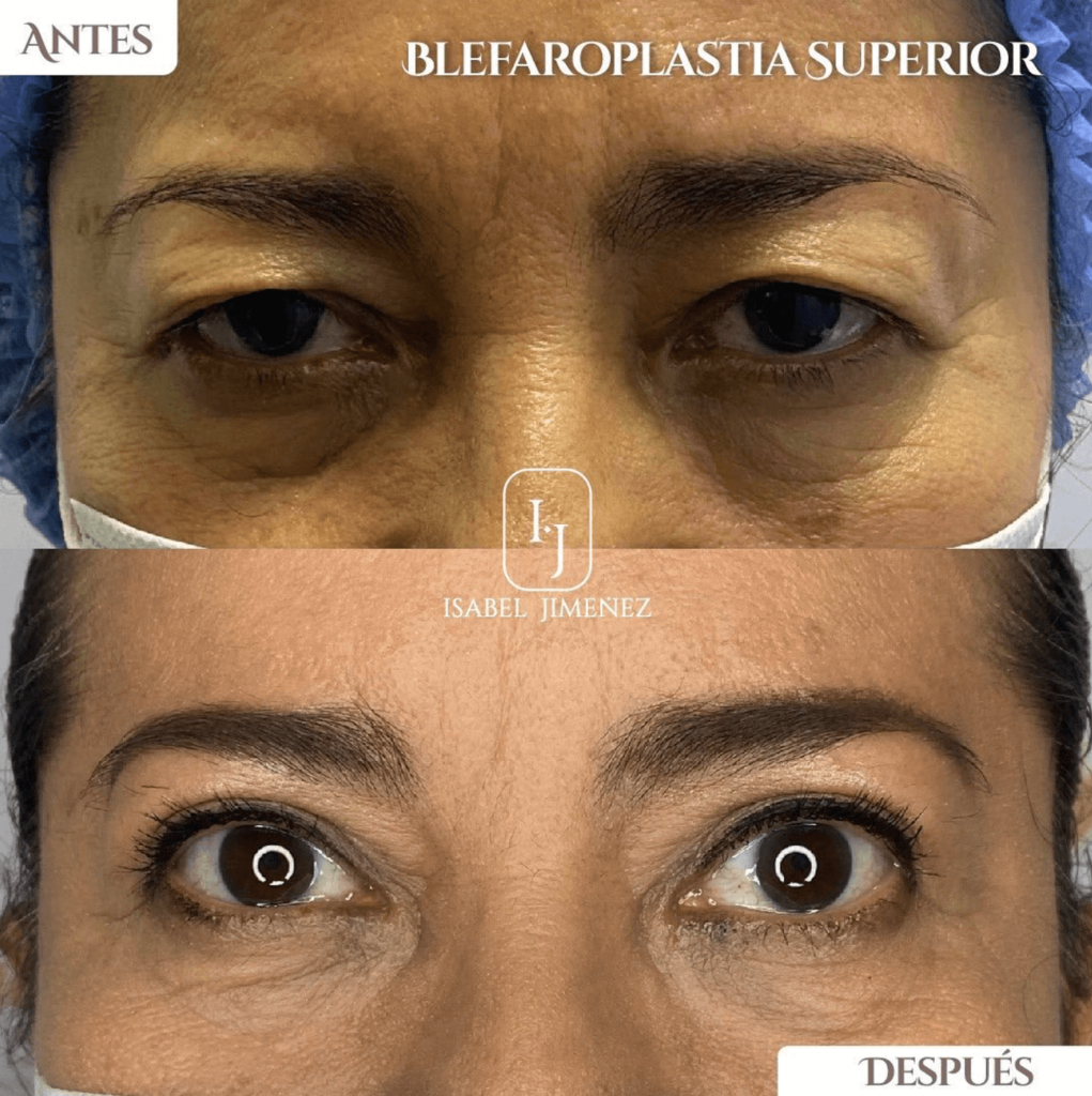 Blefaroplastia Dra Isabel Jimenez