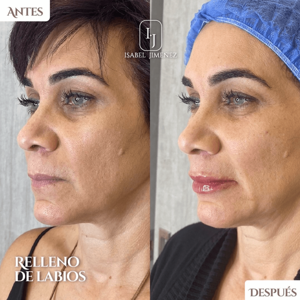 Relleno de Labios Dra Isabel Jimenez