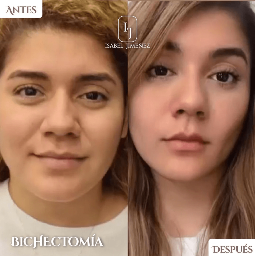 Bichectomia Dra Isabel Jimenez