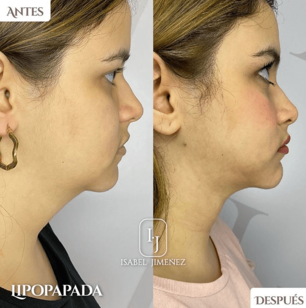 Rinoplastia Dra Isabel Jimenez
